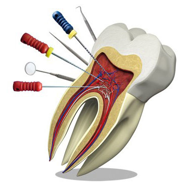 این تحقیق به بررسی چهار برند مختلف سیلر برای پر کردن کانالهای ریشه دندان می پردازد. در این تحقیق از دندان های کشیده شده استفاده شده است و برخی از این دندان ها دارای یک ریشه و برخی دیگر دارای چند ریشه بودند . 