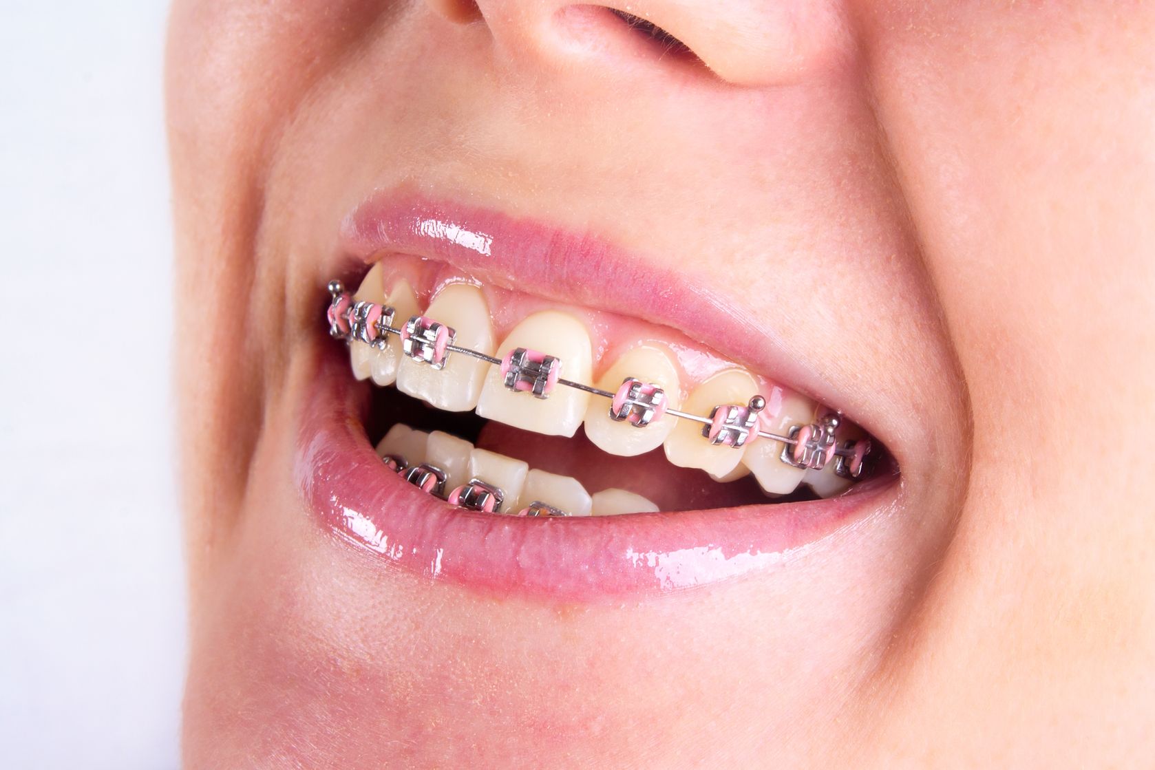 علل دندانهای نامرتب