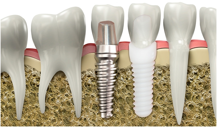 Zirconia Promises Superior Strength and Aesthetics in Dental Implants