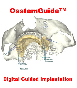 کیت Guide آستم کاتالوگ-osstem guide-کیت جراحی آستم گاید-Digital Guided Implantation-osstem