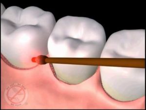 implant,dental,ایمپلنت دندانی،لیزر،layzer