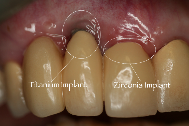 زیرکونیا،ایمپلنت،کاشت دندان