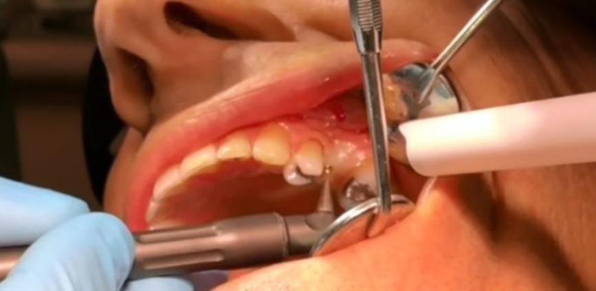 استفاده از لیزر در ایمپلنت دندانی