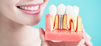 روند درمانی کشیدن دندان، مدیریت بافت وجراحی ایمپلنت دندانی در دراز مدت 