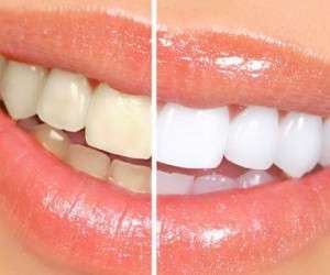 سفید کردن دندان ها در خانه بهتر است یا در مطب های دندان پزشکی