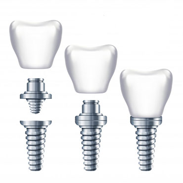 هدف از این تحقیق بررسی میزان عملکرد و رضایت دندانپزشکان در استفاده از کیت جراحی CAS kit است.