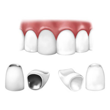 پر کننده کانال برای دندان های آسیب دیده باعث به وجود آوردن اتصال بین شکاف دیواره های داخلی دندان ها و شکاف های ایجاد شده در بین مواد پر کننده دندان می باشد. 