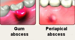 آبسه دندان،Tooth Abscess