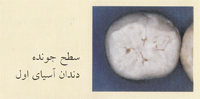 فیشور سیلنت