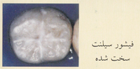 فیشور سیلنت