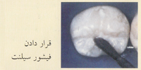 فیشور سیلنت