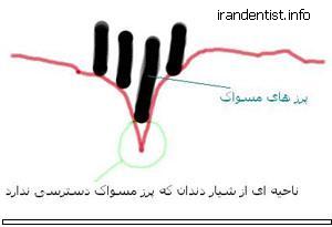 فیشور سیلنت