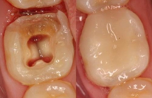 تجهیزات دندانپزشکی،ریشه دندان،عصب کشی،مواد پرکننده دندان