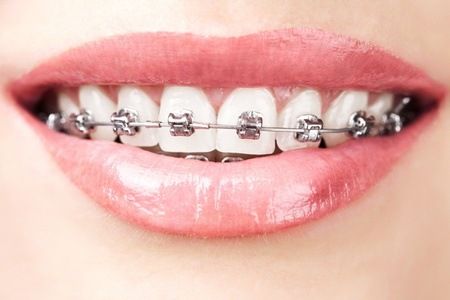 ارتودنسی ، سلامت دهان و دندان ، دندانهای نامرتب ، کجی دندان