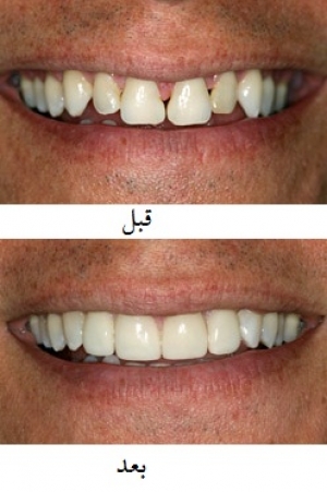 کامپوزیت دندان ، دندانپزشکی ، دهان و دندان