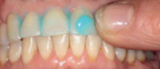 Brushing teeth New massage method quadruples protection against tooth decay, study suggests