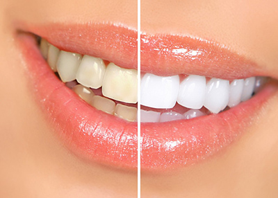 ۶ راه خانگی برای سفید کردن دندان‌ها
