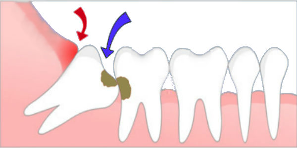 دندان عقل ، دندان آسیاب ، کشیدن دندان ، پوسیدگی دندان ، جراحی دندان ، جراحی دندان عقل ، بهداشت دهان و دندان