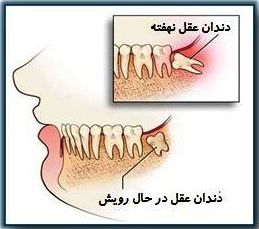 دندان عقل، جراحی دندان