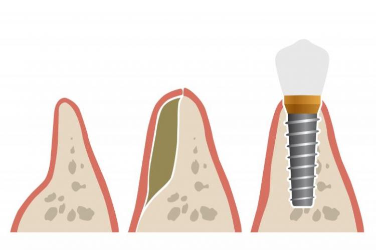 ایمپلنت،ایمپلنت دندان،پیوند استخوان