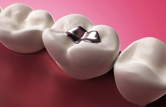 پرکننده دندان،آمالگام،کامپوزیت،ترمیمی