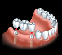 ایمپلنت،فیکسچر،اباتمنت،دندان مصنوعی