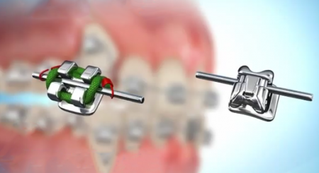 سیستم دیمون،ارتودنسی