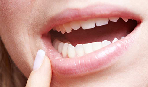 سلامتی دهان و دندان،آفت دهان،سوختگی،سرطان دهان