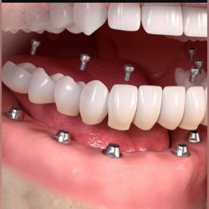 implant,ایمپلنت