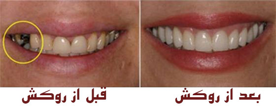 پرستودنتيكس ، پروتزهای دندانی ، دندانپزشکی ، علوم پزشکی