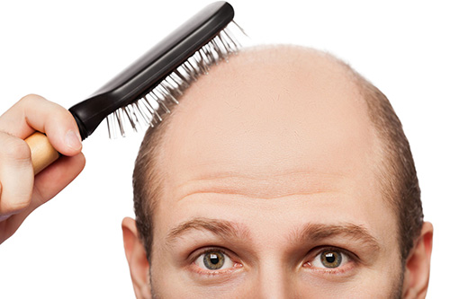 دلایل اصلی ریزش مو در مردان و زنان