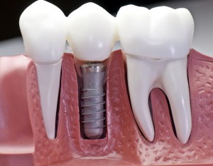 کاشت دندان یا ایمپلنت چیست؟