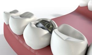 اطلاعاتی درباره دندان و آشنایی با پرکننده‌های دندانی