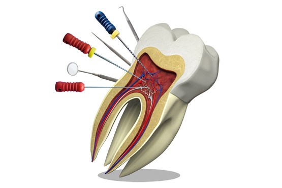 روش جدید درمان ریشه دندان