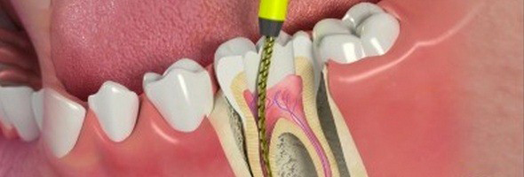 بیماران بعد از انجام روت کانال تا چه زمانی در دندان خود درد احساس می کنند؟