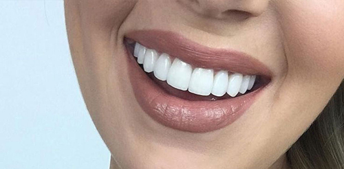 چگونه باندینگ دندان می تواند شکل ظاهری دندان ها را تغییر دهد