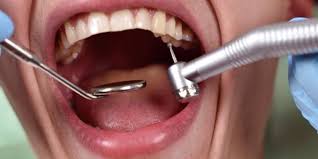 ارزیابی پوسیدگی دندان ها