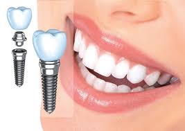 مزایای استفاده از ایمپلنت دندان