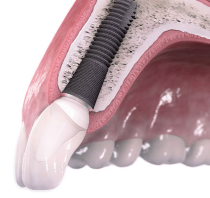 موفقیت در ایمپلنت دندانی