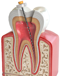 اندودنتیک Endodontic