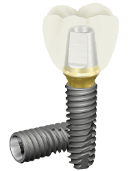  ایمپلنت  Implants