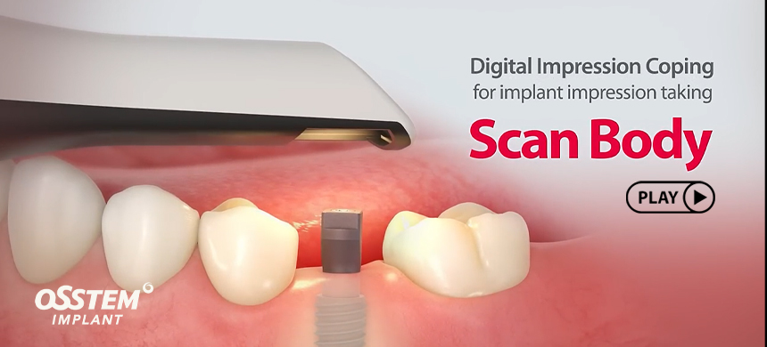 فیلم آموزشی، اسکن بادی، scan body ، osstem، implant